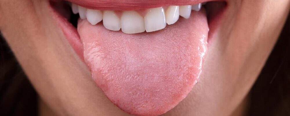 What Questions to Ask If You Have A Scalloped Tongue