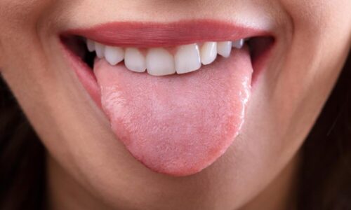 What Questions to Ask If You Have A Scalloped Tongue