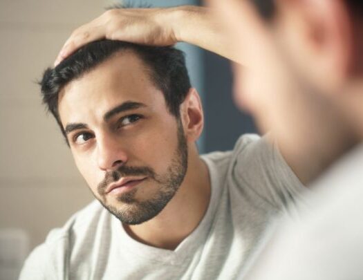 How to Minimize Balding